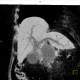 Pseudocyst of pancreas, compression of bile duct, MinIP: CT - Computed tomography